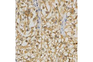 Immunohistochemistry of paraffin-embedded human kidney cancer using ADRBK2 antibody at dilution of 1:200 (x400 lens) (ADRBK2 anticorps  (AA 1-300))