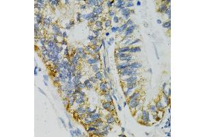 Immunohistochemistry of paraffin-embedded human gastric cancer using SLC27A2 antibody (ABIN5970435) at dilution of 1/100 (40x lens). (SLC27A2 anticorps)