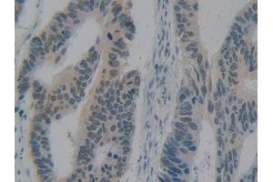 Detection of HMGB1 in Human Colorectal cancer Tissue using Polyclonal Antibody to High Mobility Group Protein 1 (HMGB1) (HMGB1 anticorps  (AA 9-163))