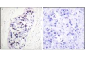Immunohistochemistry analysis of paraffin-embedded human lung carcinoma tissue, using HDAC1 Antibody.