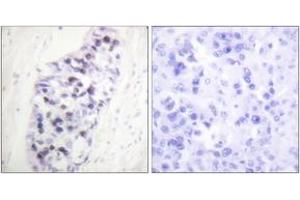 Immunohistochemistry analysis of paraffin-embedded human lung carcinoma tissue, using HDAC1 Antibody. (HDAC1 anticorps  (AA 433-482))