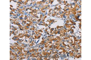 Immunohistochemistry of Human liver cancer using TSPEAR Polyclonal Antibody at dilution of 1:50 (TSPEAR anticorps)