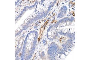 Immunohistochemistry of paraffin-embedded human colon carcinoma using CD146/MCAM Rabbit pAb (ABIN6127568, ABIN6143621, ABIN6143622 and ABIN6218100) at dilution of 1:25 (40x lens). (MCAM anticorps  (AA 447-646))