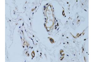 Immunohistochemistry of paraffin-embedded human colon carcinoma using MCAM antibody. (MCAM anticorps)