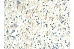 Detection of VF in Human Glioma Tissue using Polyclonal Antibody to Visfatin (VF) (NAMPT anticorps  (AA 1-491))