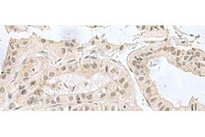 Immunohistochemistry of paraffin-embedded Human thyroid cancer tissue using PCBD1 Polyclonal Antibody at dilution of 1:60(x200) (PCBD1 anticorps)