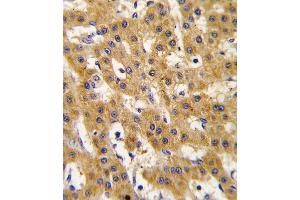 Formalin-fixed and paraffin-embedded human hepatocarcinoma tissue reacted with Phospho-PDX1-T11. (PDX1 anticorps  (AA 1-30))