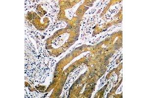 Immunohistochemical analysis of p53 staining in human colon cancer formalin fixed paraffin embedded tissue section. (p53 anticorps  (C-Term))