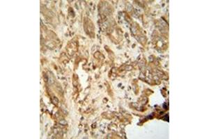 Immunohistochemistry analysis in formalin fixed and paraffin embedded human hepatocarcinoma reacted with NAT14 Antibody (N-term) followed which was peroxidase conjugated to the secondary antibody and followed by DAB staining. (NAT14 anticorps  (N-Term))