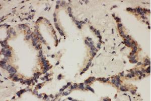 Anti- CUL1antibody, IHC(P) IHC(P): Human Lung Cancer Tissue
