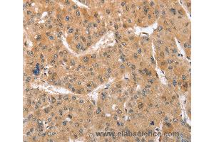 Immunohistochemistry of Human gastric cancer using ATG12 Polyclonal Antibody at dilution of 1:70 (ATG12 anticorps)