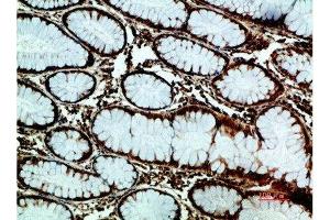 Immunohistochemical analysis of paraffin-embedded human-colon-cancer, antibody was diluted at 1:200