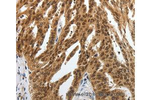 Immunohistochemistry of Human lung cancer using SUMO1 Polyclonal Antibody at dilution of 1:30 (SUMO1 anticorps)