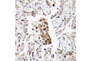 Immunohistochemistry of paraffin-embedded human lung cancer using TLR8 Rabbit pAb (ABIN3022014, ABIN3022015, ABIN3022016, ABIN1513616 and ABIN6218568) at dilution of 1:150 (40x lens).