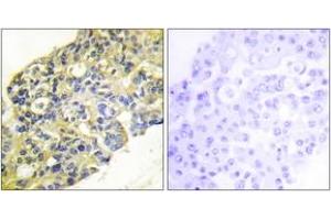 Immunohistochemistry analysis of paraffin-embedded human breast carcinoma tissue, using PI3-kinase p85-alpha/gamma (Ab-467/199) Antibody. (PI3K p85 alpha/gamma anticorps  (AA 436-485))