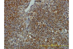 Immunoperoxidase of monoclonal antibody to CLTB on formalin-fixed paraffin-embedded human transitional cell carcinoma tissue.