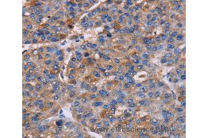 Immunohistochemistry of Human liver cancer using NPM3 Polyclonal Antibody at dilution of 1:60 (NPM3 anticorps)