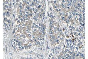 ABIN6278486 at 1/100 staining human lung carcinoma tissue sections by IHC-P. (KCNMA1 anticorps  (Internal Region))