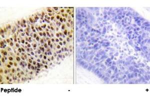 Immunohistochemical analysis of paraffin-embedded human liver carcinoma tissue using KAT5 polyclonal antibody . (KAT5 anticorps)
