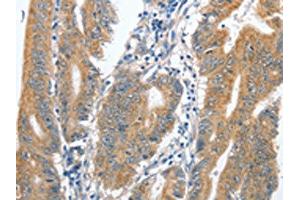 The image on the left is immunohistochemistry of paraffin-embedded Human colon cancer tissue using ABIN7128903(CENPC Antibody) at dilution 1/70, on the right is treated with fusion protein. (Centromere Protein C Pseudogene 1 (CENPCP1) anticorps)