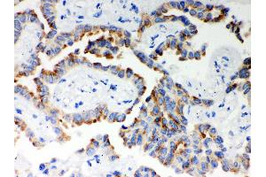 Anti- ITPR3 Picoband antibody, IHC(P) IHC(P): Human Lung Cancer Tissue (ITPR3 anticorps  (N-Term))