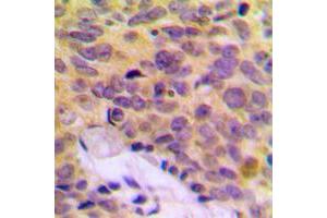 Immunohistochemical analysis of MRPL16 staining in human breast cancer formalin fixed paraffin embedded tissue section.