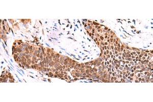 Immunohistochemistry of paraffin-embedded Human esophagus cancer tissue using TSEN2 Polyclonal Antibody at dilution of 1:80(x200) (TSEN2 anticorps)