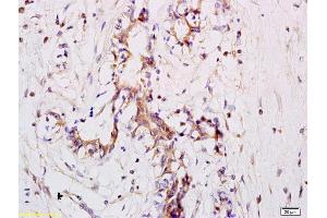 Formalin-fixed and paraffin embedded human breast carcinoma labeled with Anti CD11a Polyclonal Antibody, Unconjugated (ABIN734678) at 1:200 followed by conjugation to the secondary antibody and DAB staining (ITGAL anticorps  (AA 251-350))