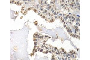 Immunohistochemistry of paraffin-embedded Human thyroid cancer using GTF2F1 Polyclonal Antibody at dilution of 1:200 (40x lens). (GTF2F1 anticorps)