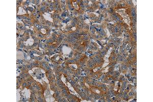 Immunohistochemistry of Human lung cancer using PER2 Polyclonal Antibody at dilution of 1:50 (PER2 anticorps)