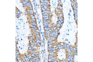 Immunohistochemistry of paraffin-embedded human colon carcinoma using YB-1/YB-1/YBX1 antibody (ABIN6134494, ABIN6150328, ABIN6150330 and ABIN7101815) at dilution of 1:100 (40x lens).