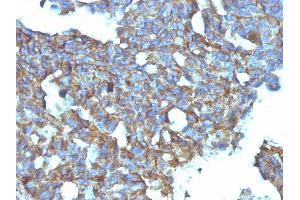 Formalin-fixed, paraffin-embedded human Ovarian Carcinoma stained with CD99 Monoclonal Antibody (MIC2/877). (CD99 anticorps)