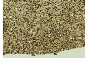 ABIN6272432 at 1/100 staining Human breast cancer tissue by IHC-P. (Sp3/4 anticorps)