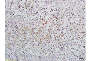 Formalin-fixed and paraffin embedded human nasopharyngeal carcinoma labeled with Rabbit Anti-IGFBP7 Polyclonal Antibody, Unconjugated  at 1:200 followed by conjugation to the secondary antibody and DAB staining (IGFBP7 anticorps  (AA 131-230))