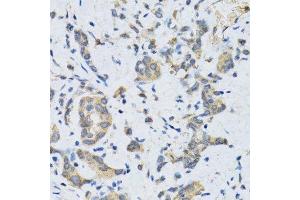 Immunohistochemistry of paraffin-embedded human gastric cancer using SLC2A13 antibody. (SLC2A13 anticorps  (AA 564-648))