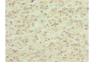 Immunohistochemistry of paraffin-embedded human glioma using ABIN7151143 at dilution of 1:100 (RNF13 anticorps  (AA 204-381))