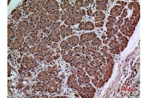 Immunohistochemistry (IHC) analysis of paraffin-embedded Human Pancreas Cancer, antibody was diluted at 1:100. (SERPINA3 anticorps  (Internal Region))