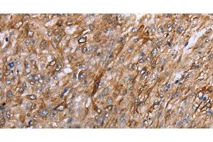 Immunohistochemistry of paraffin-embedded Human esophagus cancer using GRPR Polyclonal Antibody at dilution of 1:40