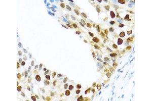 Immunohistochemistry of paraffin-embedded Human prostate cancer using KHDRBS2 Polyclonal Antibody at dilution of 1:100 (40x lens). (KHDRBS2 anticorps)
