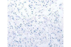Immunohistochemistry (IHC) image for anti-Matrix Metallopeptidase 11 (Stromelysin 3) (MMP11) antibody (ABIN1873715) (MMP11 anticorps)