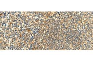 Immunohistochemistry of paraffin-embedded Human tonsil tissue using CLEC4D Polyclonal Antibody at dilution of 1:50(x200) (CLEC4D anticorps)