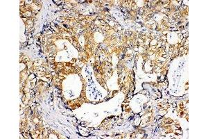 IHC-P: SDHC antibody testing of human gastric cancer tissue (SDHC anticorps  (N-Term))