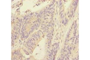 Immunohistochemistry of paraffin-embedded human colon cancer using ABIN7170628 at dilution of 1:100