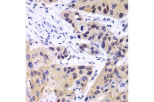 Immunohistochemistry of paraffin-embedded human esophageal cancer using IRF3 antibody (ABIN4904079) at dilution of 1:100 (40x lens).