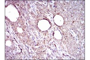 Immunohistochemical analysis of paraffin-embedded cervical cancer tissues using ALDH2 mouse mAb with DAB staining.