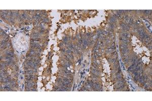 Immunohistochemistry of paraffin-embedded Human colon cancer using REG3G Polyclonal Antibody at dilution of 1:40