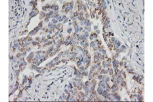 Immunohistochemical staining of paraffin-embedded Carcinoma of Human lung tissue using anti-HOXC11 mouse monoclonal antibody. (HOXC11 anticorps)