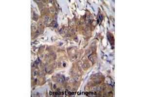 ATP6V1B1 Antibody (C-term) immunohistochemistry analysis in formalin fixed and paraffin embedded human breast carcinoma followed by peroxidase conjugation of the secondary antibody and DAB staining. (ATP6V1B1 anticorps  (C-Term))