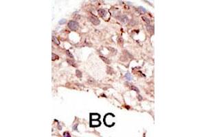 Formalin-fixed and paraffin-embedded human cancer tissue reacted with the SUV39H2 polyclonal antibody  , which was peroxidase-conjugated to the secondary antibody, followed by DAB staining. (SUV39H2 anticorps  (AA 308-337))
