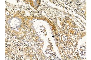 ABIN7093122 and ABIN7098213 at 1/100 staining human gastric cancer by IHC-P. (DLEU1 anticorps  (C-Term))